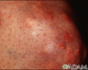 Xanthoma on the knee