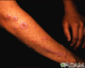 Lichen planus on the arm