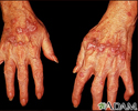 Lichen planus on the hands