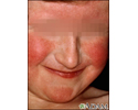 Dermatitis - atopic on a young girl's face