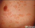 Pityriasis rosea on the chest