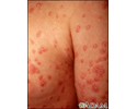 Psoriasis - guttate on the arms and chest