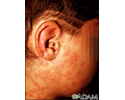 Psoriasis - guttate on the cheek