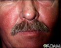 Systemic lupus erythematosus rash on the face