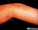 Herpes zoster (shingles) on the arm