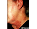 Herpes zoster (shingles) on the neck and cheek