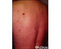 Kaposi sarcoma on the back