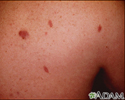 Kaposi sarcoma - close-up