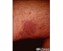 Kaposi sarcoma on the thigh