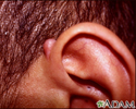Keloid above the ear