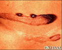 Keloid - pigmented
