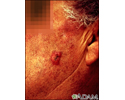 Squamous cell carcinoma - invasive