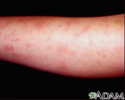 Erythema nodosum associated with sarcoidosis