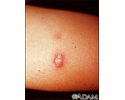 Sarcoidosis - close-up