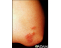 Sarcoidosis on the elbow