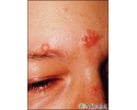 Sarcoidosis on the nose and forehead