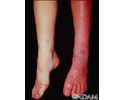 Sturge-Weber syndrome - legs