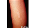 Tuberous sclerosis - hypopigmented macule