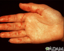 Vasculitis on the palm