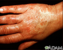 Vasculitis - urticarial on the hand
