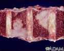 Spinal tumor