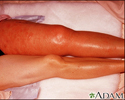 Deep venous thrombosis - iliofemoral