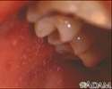 Measles, Koplik spots - close-up