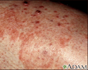 Granuloma - fungal (Majocchi's)