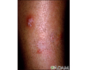 Granuloma - fungal (Majocchi's)