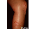 Poison ivy on the leg