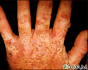 Porphyria cutanea tarda on the hands