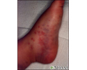 Henoch-Schonlein purpura on an infant's foot
