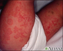 Henoch-Schonlein purpura on an infant's legs