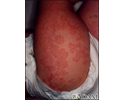 Henoch-Schonlein purpura on an infant's legs