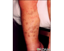 Henoch-Schonlein purpura on the legs