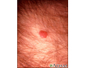 Kaposi sarcoma - perianal