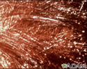 Head louse infestation - scalp