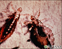 Lice, body with stool (Pediculus humanus)