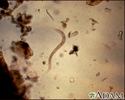 Hookworm rhabditiform larva