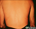 Strongyloidiasis, creeping eruption on the back
