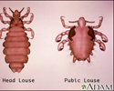 Head louse and pubic louse