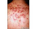 Acne - close-up of cysts on the back