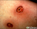 Ecthyma gangrenosum