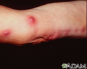 Sporotrichosis on the arm