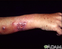 Sporotrichosis on the forearm