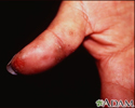 Dermatitis herpetiformis on the thumb