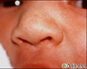 Milia - nose