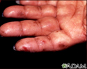Dermatitis herpetiformis on the hand