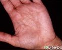 Hyperlinearity in atopic dermatitis