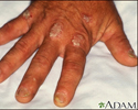 Psoriasis on the knuckles